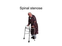 Spinal stenose Lars Grøvle
