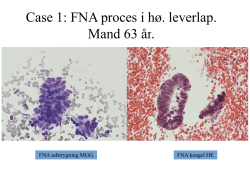 Case1:FNA proces i hø. leverlap. Mand 63år.